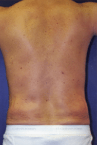 After Image: Male Body Contouring - back