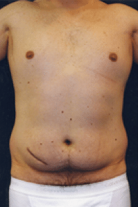 Before Image: Male Body Contouring - front