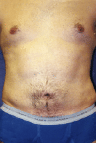 After Image: Male Body Contouring - front