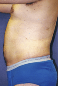 After Image: Male Body Contouring - left-side