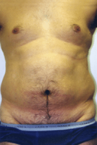 Before Image: Male Body Contouring - front