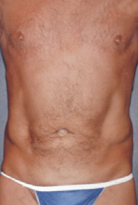 After Image: Male Body Contouring - front
