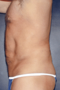 After Image: Male Body Contouring - left-side