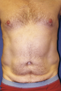 Before Image: Male Body Contouring - front