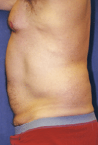 Before Image: Male Body Contouring - left-side