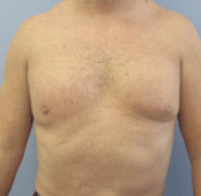 After Image: Male Body Contouring - front