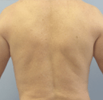 After Image: Male Body Contouring - back