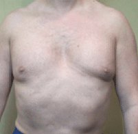 Before Image: Male Body Contouring - front