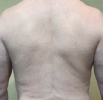 Before Image: Male Body Contouring - back