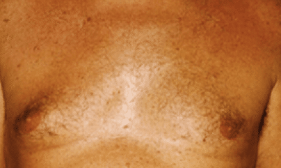 After Image: Male Body Contouring - front