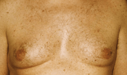 Before Image: Male Body Contouring - front