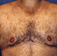 After Image: Male Body Contouring - front