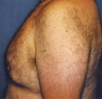 After Image: Male Body Contouring - left-side