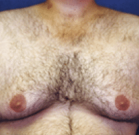 Before Image: Male Body Contouring - front
