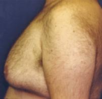 Before Image: Male Body Contouring - left-side