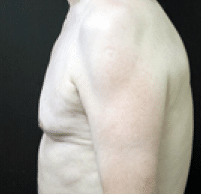 After Image: Male Body Contouring - left-side