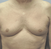 Before Image: Male Body Contouring - front