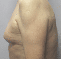 Before Image: Male Body Contouring - left-side