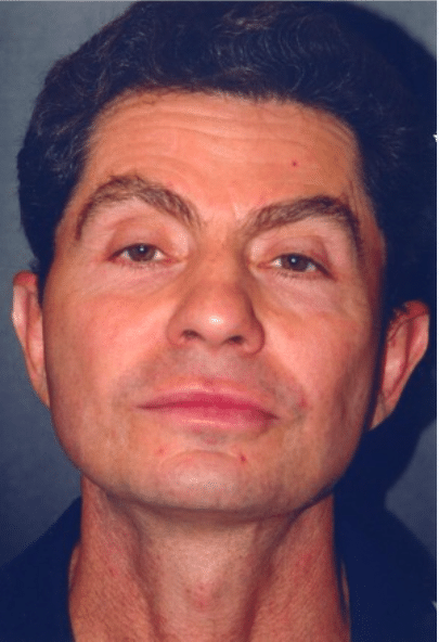 After Image: Male Facial Procedures - front