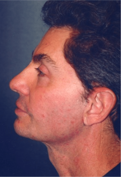 After Image: Male Facial Procedures - left-side