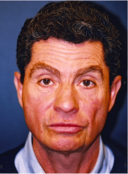 Before Image: Male Facial Procedures - front