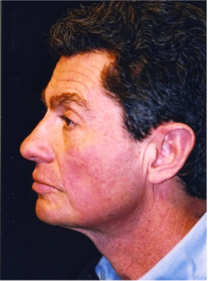 Before Image: Male Facial Procedures - left-side