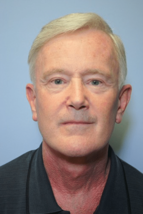 After Image: Male Facial Procedures - front