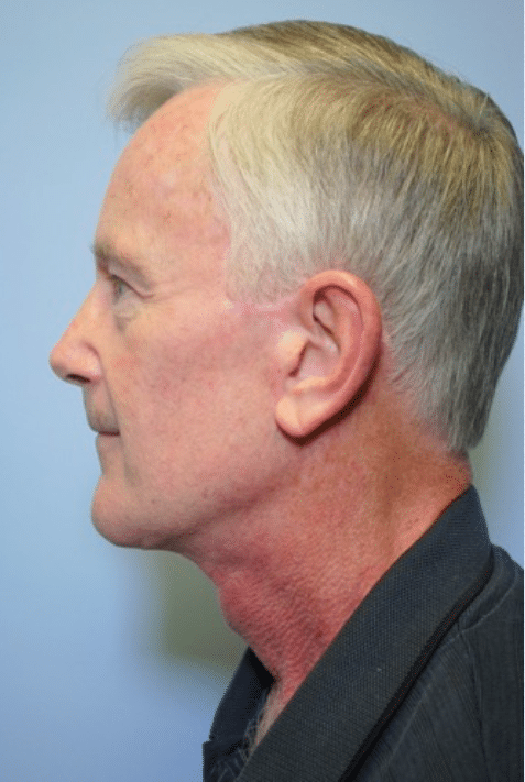 After Image: Male Facial Procedures - left-side
