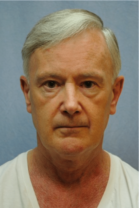 Before Image: Male Facial Procedures - front