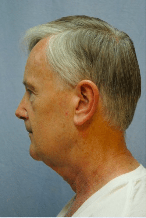 Before Image: Male Facial Procedures - left-side