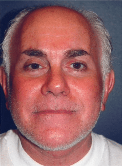 After Image: Male Facial Procedures - front