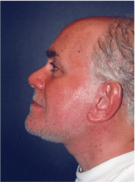 After Image: Male Facial Procedures - left-side