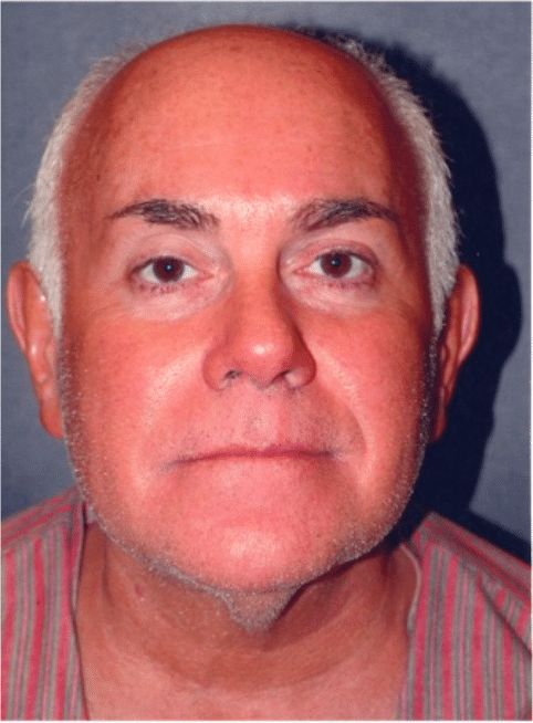 Before Image: Male Facial Procedures - front