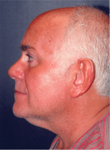 Before Image: Male Facial Procedures - left-side