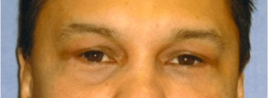 After Image: Male Facial Procedures - front