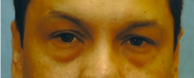 Before Image: Male Facial Procedures - front