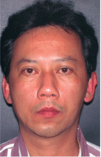 After Image: Male Facial Procedures - front