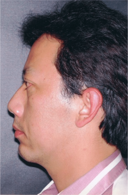 After Image: Male Facial Procedures - left-side