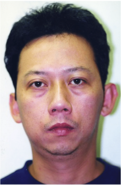 Before Image: Male Facial Procedures - front