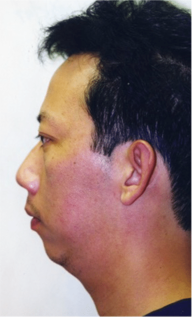 Before Image: Male Facial Procedures - left-side