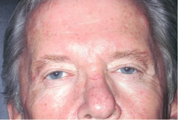After Image: Male Facial Procedures - front