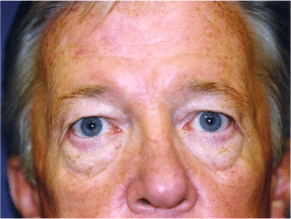 Before Image: Male Facial Procedures - front