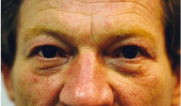 Before Image: Male Facial Procedures - front