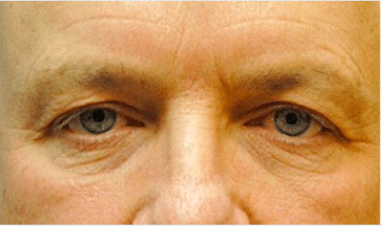 Before Image: Male Facial Procedures - front
