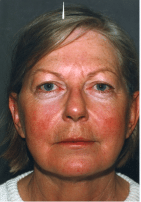 After Image: Neck Liposuction, Platysmaplasty, Chin Implant - front