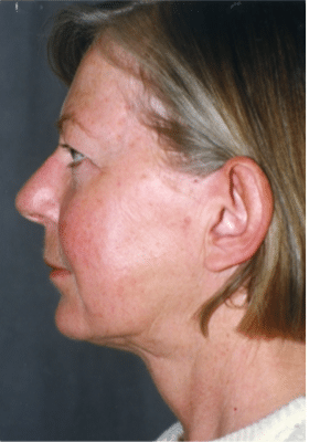After Image: Neck Liposuction, Platysmaplasty, Chin Implant - left-side