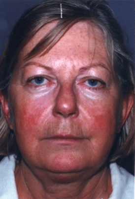 Before Image: Neck Liposuction, Platysmaplasty, Chin Implant - front
