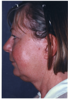 Before Image: Neck Liposuction, Platysmaplasty, Chin Implant - left-side