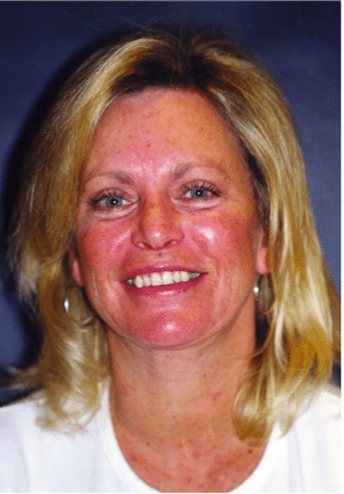After Image: Neck Liposuction, Platysmaplasty, Chin Implant - front