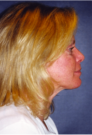 After Image: Neck Liposuction, Platysmaplasty, Chin Implant - right-side